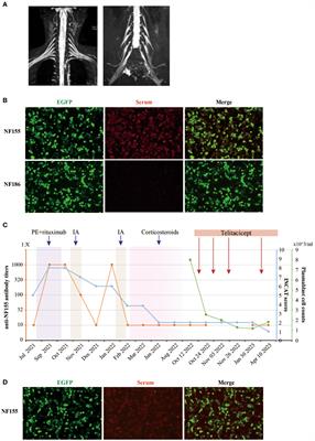 Case Report: Telitacicept in treating a patient with NF155+ autoimmune nodopathy: a successful attempt to manage recurrent elevated sero-anti-NF155 antibodies